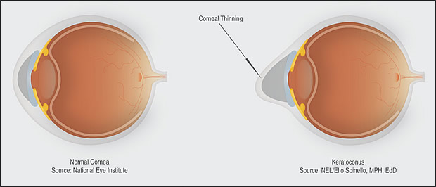 keratoconus
